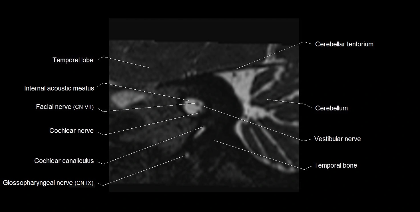 Internal auditory meatus (IAM) 3T sagittal cross sectional anatomy image 20.webp